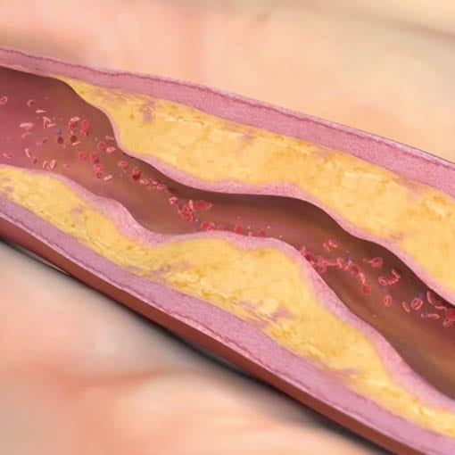 Arteriosklerose: alles über die Entstehung, Diagnostik und Therapie