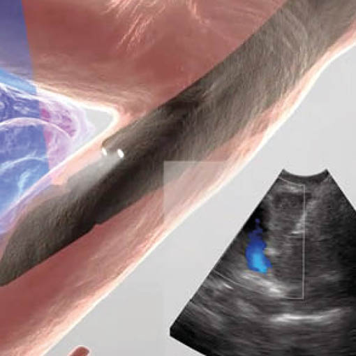 Hochauflösender Ultraschall und Endoskopie kombiniert: Endosonographie